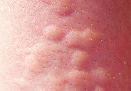 Аллергия: волдыри на коже, фото